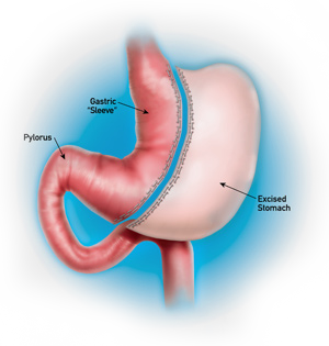 Sleeve Gastrectomy